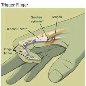 triger finger