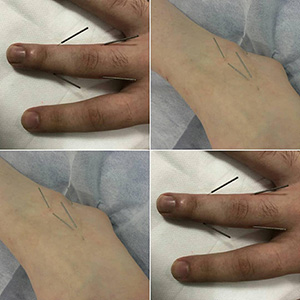 Dry-needling